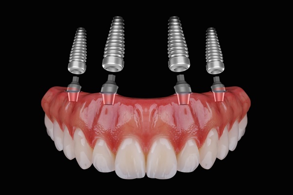 Common Issues With All On Implants And How To Avoid Them
