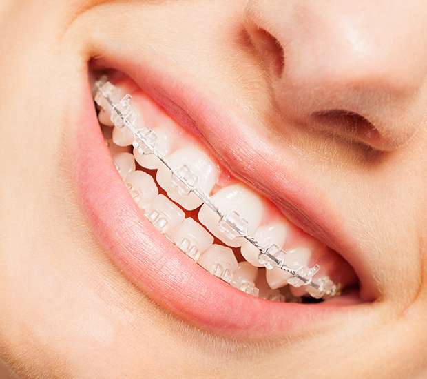 Plano Clear Braces