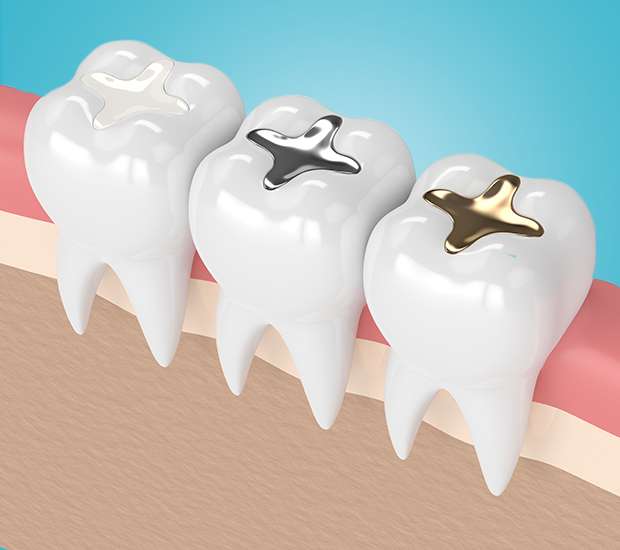 Plano Composite Fillings