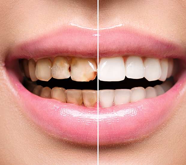 Plano Dental Implant Restoration