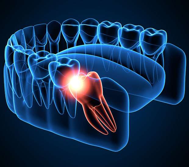 Plano Wisdom Teeth Extraction